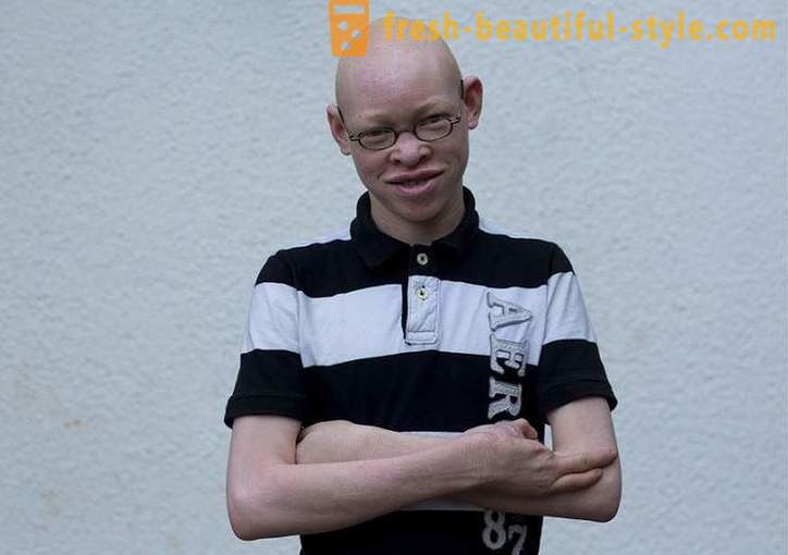 Tragiczna historia albinosów w Tanzanii