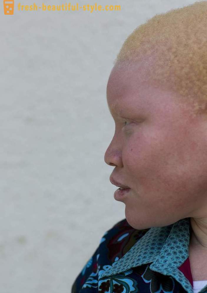 Tragiczna historia albinosów w Tanzanii