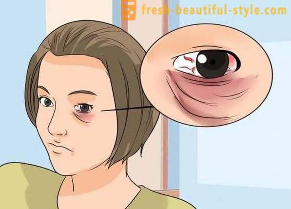 Jak zamaskować podbite oko z uderzeniem: kosmetyki, zwłaszcza zalecenia i
