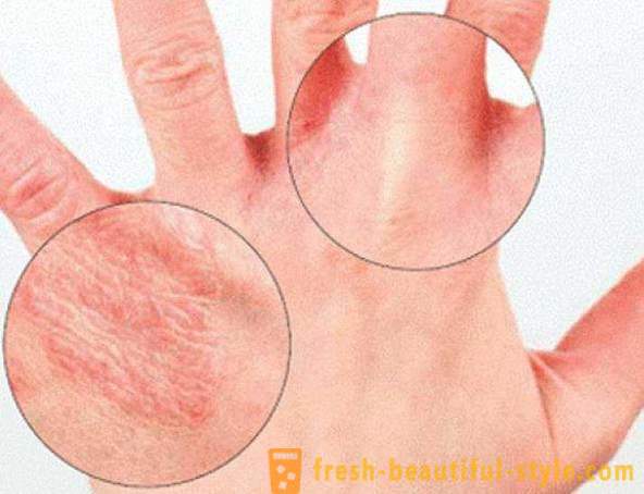 Suchość skóry rąk: Przyczyny. Bardzo sucha skóra, co robić?